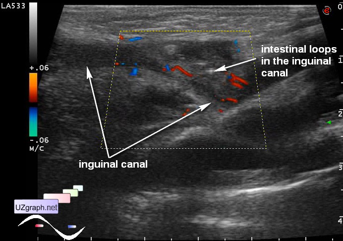 scrotal hernia ultrasound
